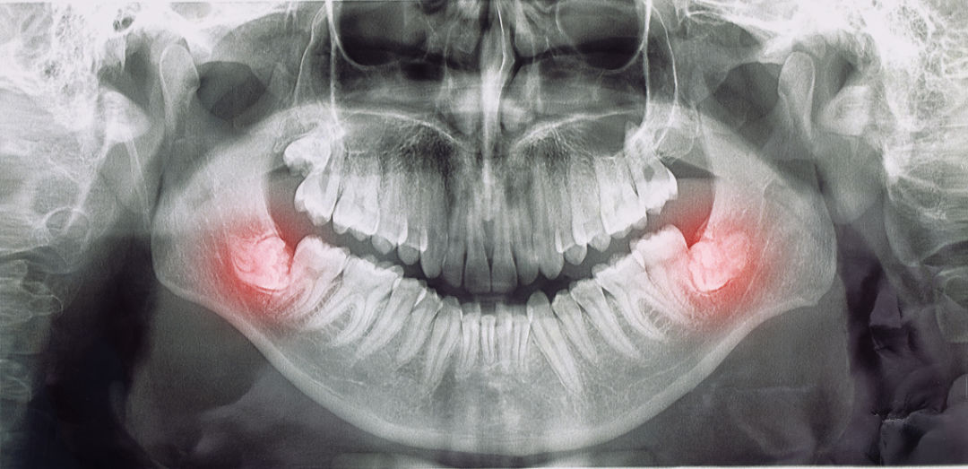 homepage der weisheitszahn zahnarzt herne dr. olivier_1
