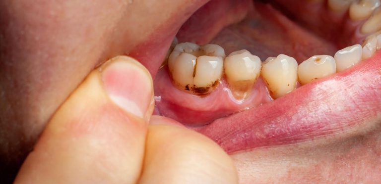 freiliegende Zahnhälse zahnarzt herne dr. olivier