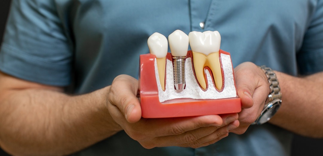 Mann hält Zahnmodell für Implantat hoch.